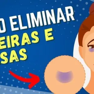 Como Se Livrar de OLHEIRAS, BOLSAS NOS OLHOS e INCHAÇO!