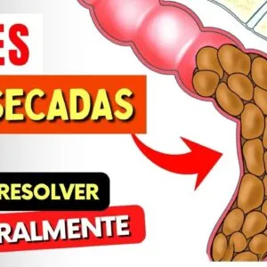 FEZES RESSECADAS e Intestino Preso - Como Resolver NATURALMENTE!