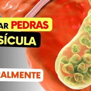 Como DISSOLVER AS PEDRAS NA VESÍCULA Naturalmente