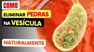 Como DISSOLVER AS PEDRAS NA VESÍCULA Naturalmente