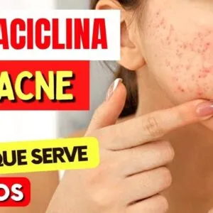 TETRACICLINA PARA ACNE e mais - O que você PRECISA SABER! Como Tomar, Riscos e Para Que Serve