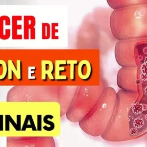 10 SINAIS de Alerta para CÂNCER de CÓLON e RETO que Todos Deveriam Saber