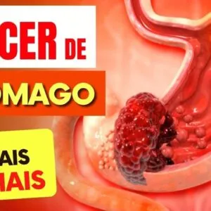 7 SINAIS de Alerta para CÂNCER DE ESTÔMAGO que Todos Deveriam Saber (e Dicas IMPORTANTES)