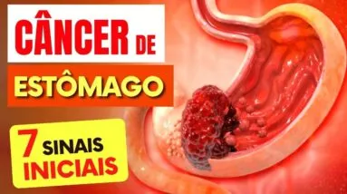 7 SINAIS de Alerta para CÂNCER DE ESTÔMAGO que Todos Deveriam Saber (e Dicas IMPORTANTES)