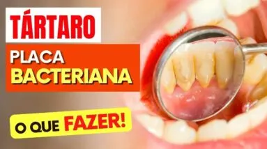 Você tem TÁRTARO (Placa bacteriana)? Vai ADORAR ISSO! (Faça DESSA FORMA)