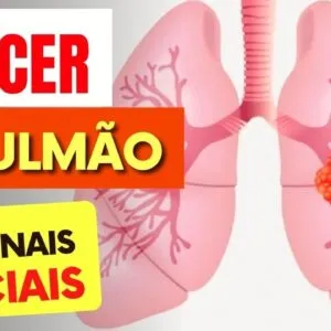 10 SINAIS de Alerta para CÂNCER de PULMÃO que Todos Deveriam Saber