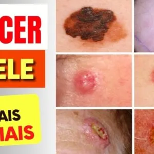 7 SINAIS de Alerta para CÂNCER DE PELE que Todos Deveriam Saber (e Dicas IMPORTANTES)