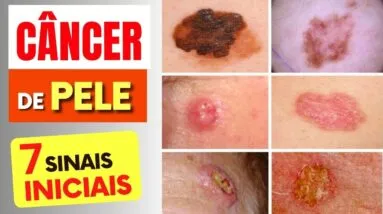 7 SINAIS de Alerta para CÂNCER DE PELE que Todos Deveriam Saber (e Dicas IMPORTANTES)