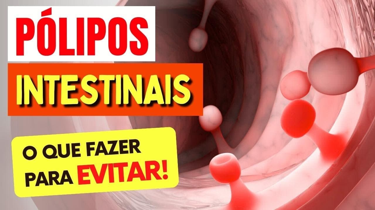 Como Evitar PÓLIPOS INTESTINAIS – O Que Você PRECISA SABER! | Saudável ...