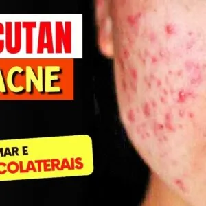 ROACUTAN PARA ACNE e mais - O que você PRECISA SABER! Como Tomar, Riscos e Para Que Serve