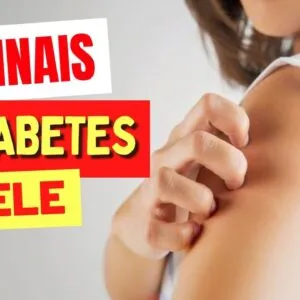 10 Principais SINAIS de DIABETES na PELE! (Sintomas de AÇÚCAR NO SANGUE)