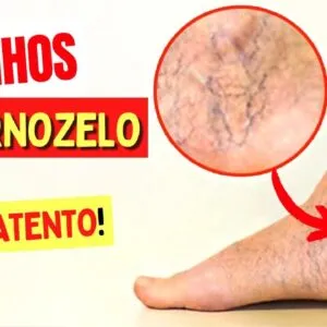 VAZINHOS NO TORNOZELO - Não Ignore este Sinal!