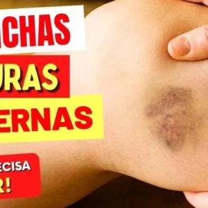 MANCHAS ESCURAS NAS PERNAS - O que você PRECISA SABER!