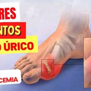 4 PIORES ALIMENTOS para ÁCIDO ÚRICO ALTO (e os MELHORES PARA BAIXAR!)