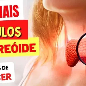 6 SINAIS PERIGOSOS de um NÓDULO na TIREOIDE (e Sintomas de Câncer na Tireóide)