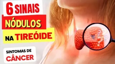 6 SINAIS PERIGOSOS de um NÓDULO na TIREOIDE (e Sintomas de Câncer na Tireóide)