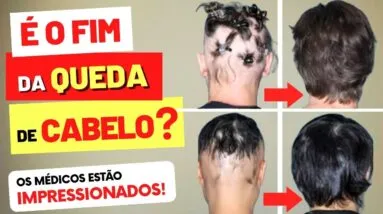 BARICITINIBE - É O FIM DA QUEDA DE CABELO? Por que os Médicos estão Impressionados?