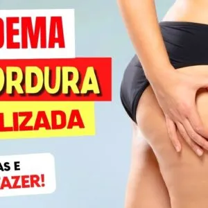 LIPEDEMA ou GORDURA LOCALIZADA - Diferenças e O QUE FAZER!