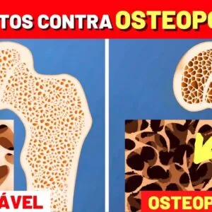 Melhores ALIMENTOS CONTRA OSTEOPOROSE e Como USAR!