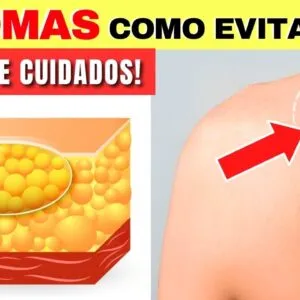 LIPOMAS (Bolas de Gordura) - Causas, Sinais e COMO EVITAR - Alimentação e Cuidados Importantes