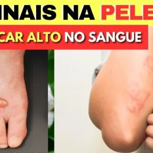 10 SINAIS na PELE de AÇÚCAR NO SANGUE ALTO (Pré-Diabates e Diabetes) e Dicas