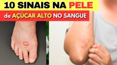 10 SINAIS na PELE de AÇÚCAR NO SANGUE ALTO (Pré-Diabates e Diabetes) e Dicas