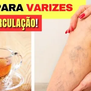 Chá para VARIZES, MÁ CIRCULAÇÃO e mais - Benefícios da Hamamélis, Como Usar e Dicas