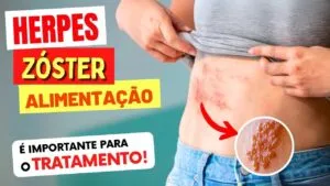 HERPES ZÓSTER - Alimentação CERTA no Tratamento e Sequelas