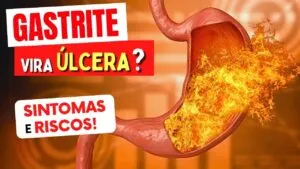 GASTRITE VIRA ÚLCERA? Sintomas e Riscos que Você Precisa Conhecer