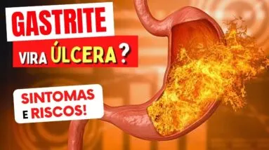 GASTRITE VIRA ÚLCERA? Sintomas e Riscos que Você Precisa Conhecer