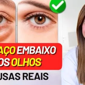 Como ELIMINAR as BOLSAS dos OLHOS - SEM COSMÉTICOS! Soluções NATURAIS Eficazes (e Causas)