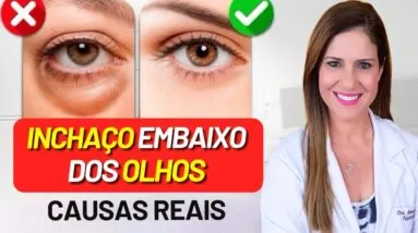 Como ELIMINAR as BOLSAS dos OLHOS - SEM COSMÉTICOS! Soluções NATURAIS Eficazes (e Causas)