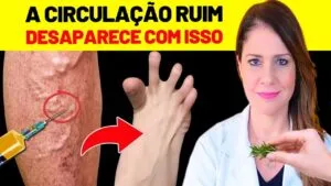 ACABE com as VARIZES NAS PERNAS com ESTE SEGREDO! - MELHORE A CIRCULAÇÃO