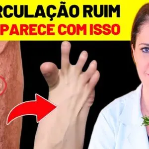 ACABE com as VARIZES NAS PERNAS com ESTE SEGREDO! - MELHORE A CIRCULAÇÃO