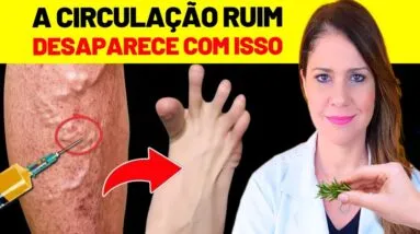 ACABE com as VARIZES NAS PERNAS com ESTE SEGREDO! - MELHORE A CIRCULAÇÃO
