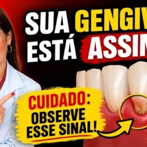 Gengiva Retraiu? CUIDADO! É um SINAL MAIS IMPORTANTE do que IMAGINA!