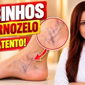 VAZINHOS NO TORNOZELO - Não Ignore este Sinal (Faça ISSO e Veja o que ACONTECE)