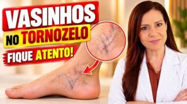 VAZINHOS NO TORNOZELO - Não Ignore este Sinal (Faça ISSO e Veja o que ACONTECE)