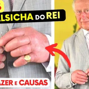 MÃOS INCHADAS do Rei! CAUSAS e o O QUE FAZER (Mãos de Salsicha!)