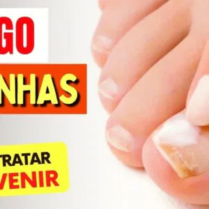 Como TRATAR e PREVENIR o FUNGO NAS UNHAS - Naturalmente!