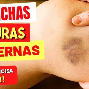 MANCHAS ESCURAS NAS PERNAS - O que você PRECISA SABER!