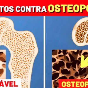 Melhores ALIMENTOS CONTRA OSTEOPOROSE e Como USAR!