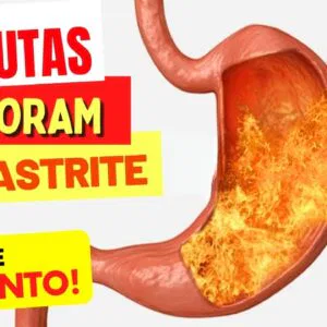 5 FRUTAS que PIORAM A GASTRITE, REFLUXO, AZIA e QUEIMAÇÃO - Fique Atento!
